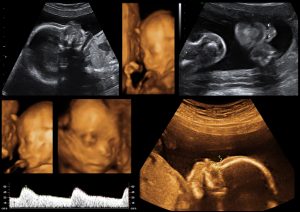2d and 3d baby ultrasound images