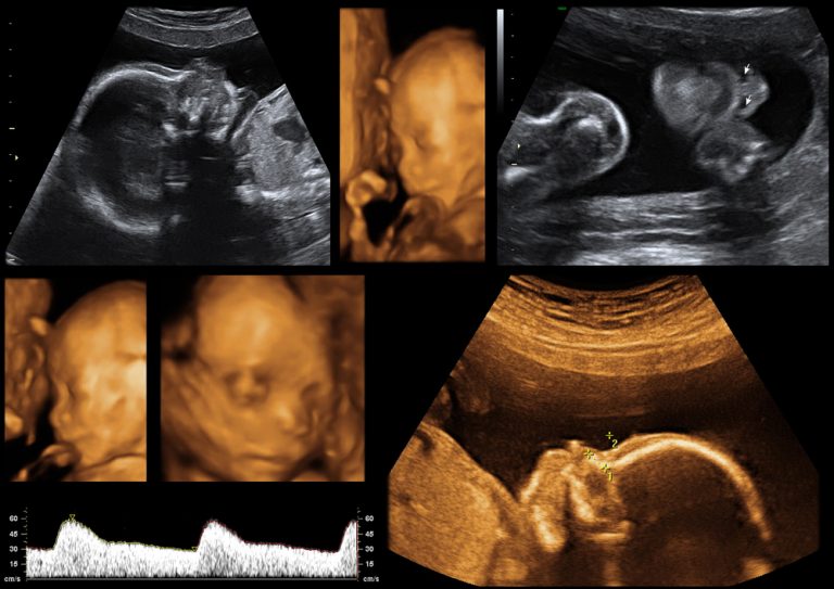 Read more about the article Understanding 2D, 3D and 4D pregnancy ultrasounds