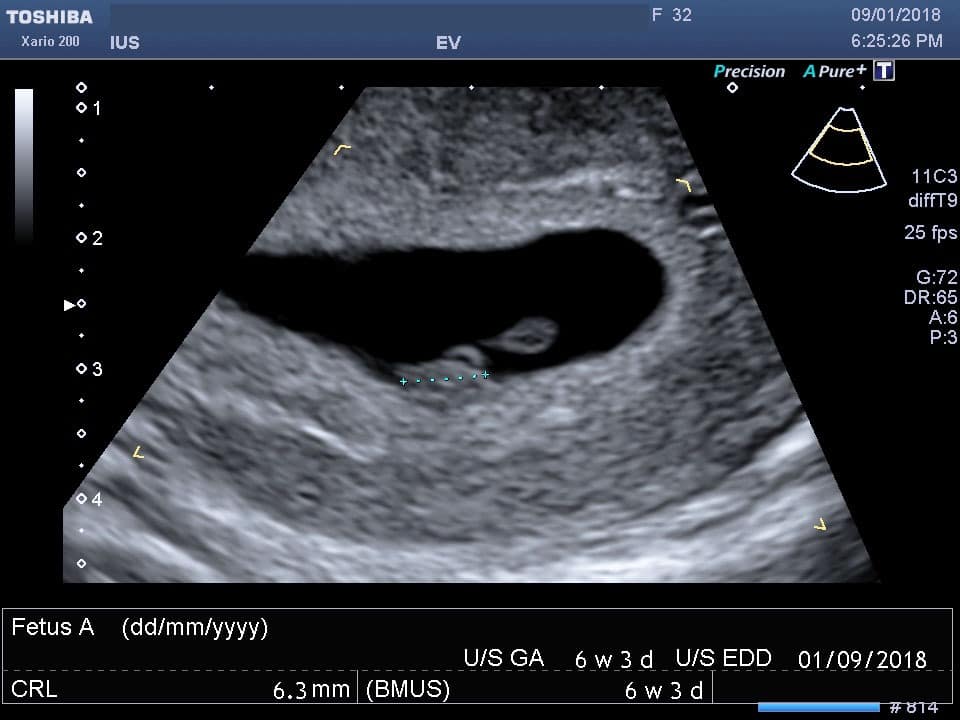 Read more about the article 6 week Pregnancy Scan