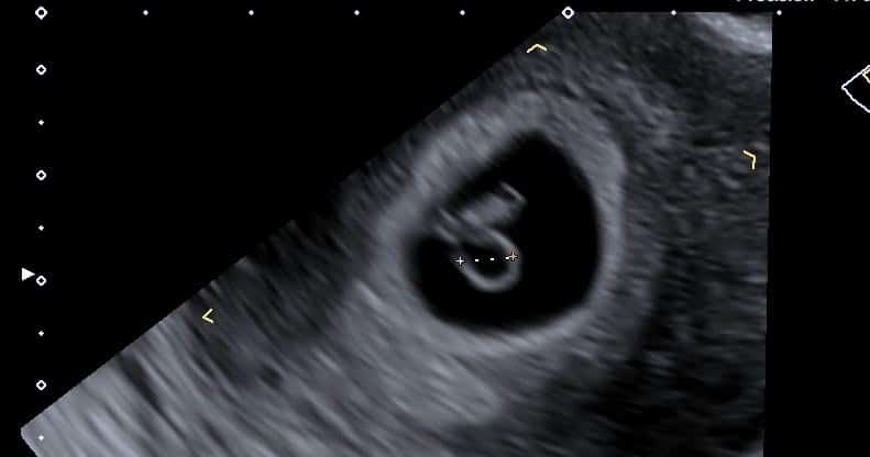 Ultrasound imaging showing the foetal pole and measuring the yolk sac at 7 weeks gestation