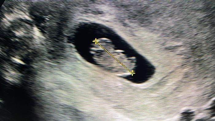 Ultrasound scan of 8 week gestation measuring the croen rump lemgth of the foetus