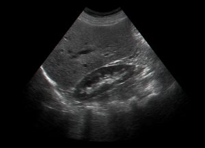 Ultrasound image of internal organs including right kidney and liver