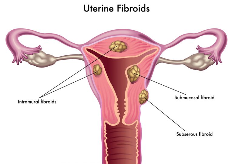 Read more about the article Ultrasound for Uterine Fibroids