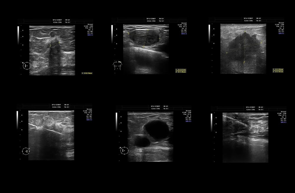 Read more about the article Ultrasound for Cancer Screening –  Questions and Answers
