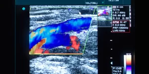 Colour doppler ultrasound image of vascular anatomy