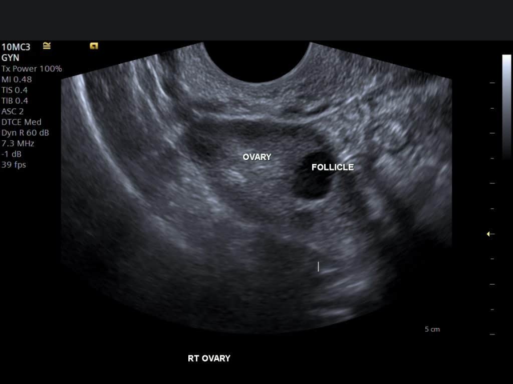 Transvaginal scan image showing an ovary with a follicle
