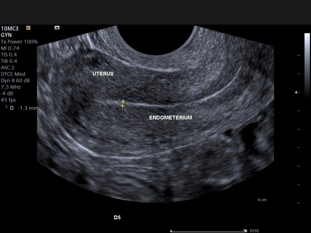 Transvaginal ultrasound image of the endometrium