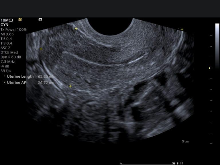 Transvaginal Ultrasound scan image of a uterus with measurements
